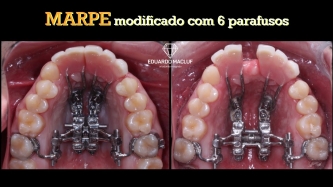 MARPE MODIFICADO com 6 parafusos para sustentar uma prótese provisória	